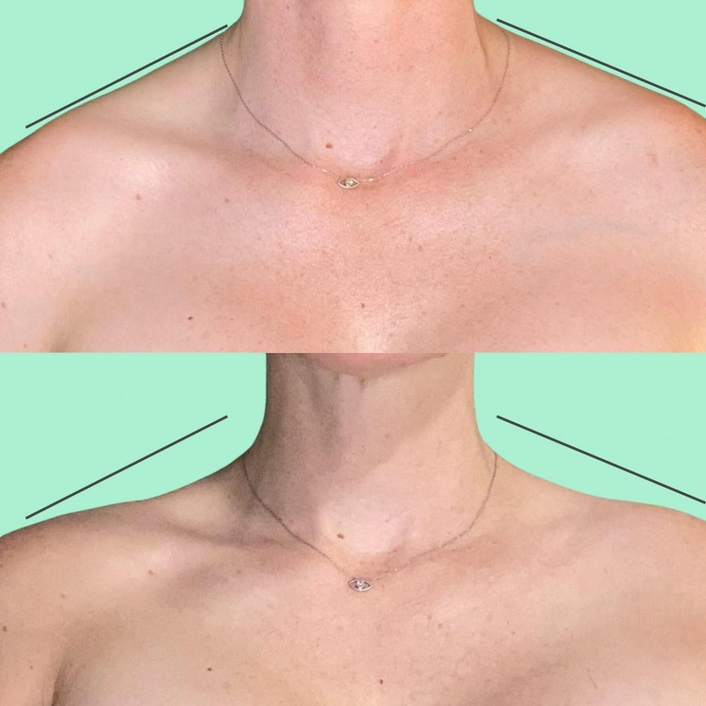 Barbie Botox: Lăng kính không phải màu hồng của trào lưu chiếc “vai mắc áo”