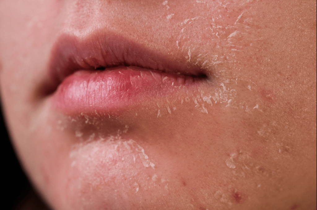 Bức tranh toàn cảnh về làn da khi bạn quá lạm dụng treatment: AHA, BHA