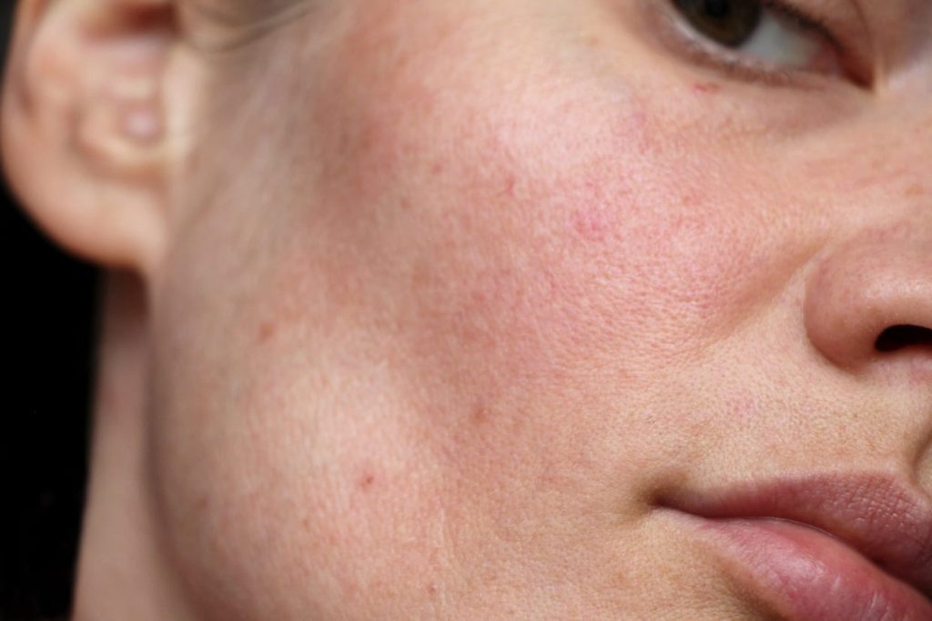 Bức tranh toàn cảnh về làn da khi bạn quá lạm dụng treatment: AHA, BHA