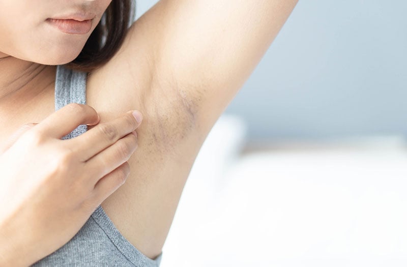Vùng da dưới cánh tay trở nên thâm sạm, kém mịn màng khiến nhiều chị em cảm thấy tự ti.