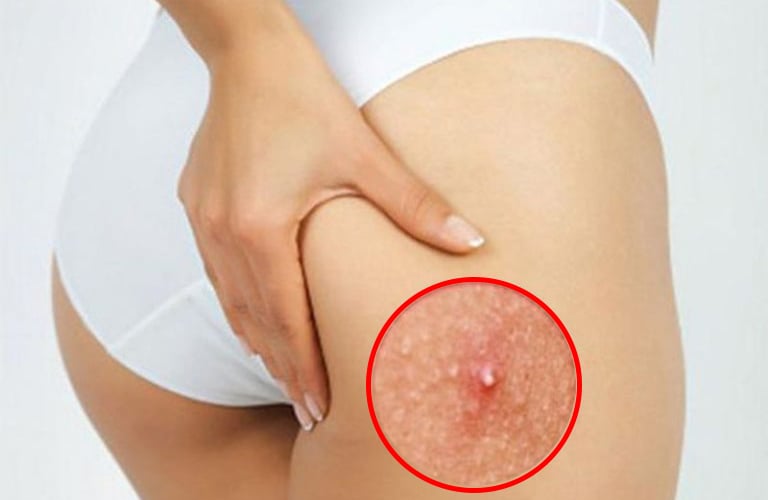Việc rửa sạch vùng da mông thường xuyên sẽ giúp nang lông thông thoáng, loại bỏ bụi bẩn, vi khuẩn, mồ hôi và dầu thừa trên da.