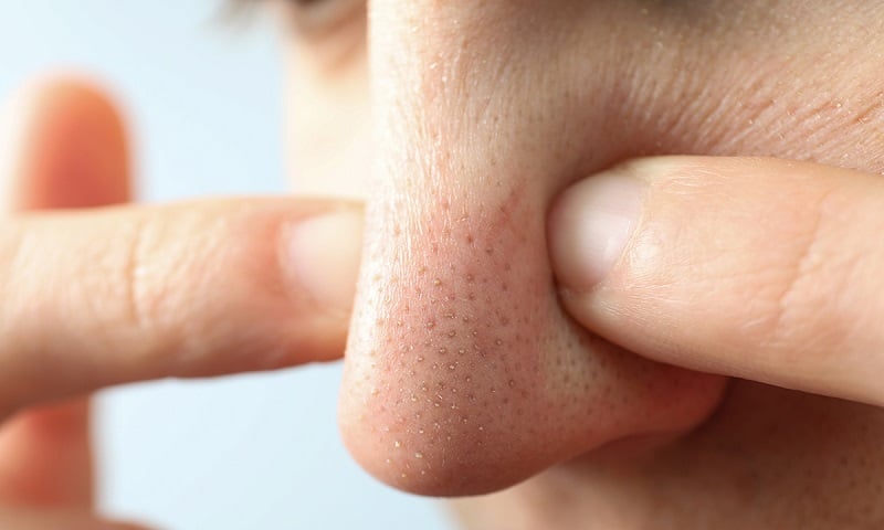 Nếu không kịp chữa trị, mụn đầu đen sẽ gây ra các vấn đề sạm da và lỗ chân lông to.