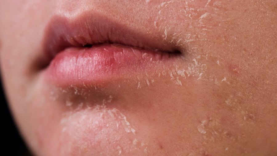 Nên thường xuyên xịt khoáng để cung cấp nước kịp thời, giúp da hạn chế khô nẻ.