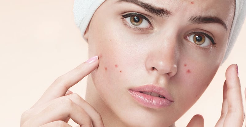 Các sản phẩm tạo kiểu tóc, đặc biệt là xịt, có thể dính vào vùng trán và mặt, chứa các thành phần dễ gây tắc nghẽn lỗ chân lông, dẫn đến mụn