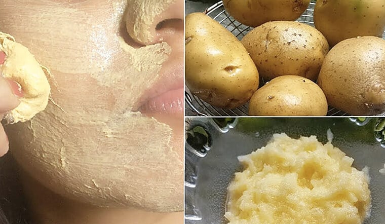 Khoai tây có khả năng làm dịu làn da cháy nắng