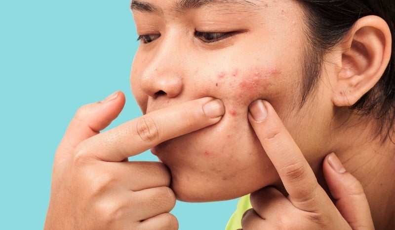Tự ý nặn mụn sẽ để lại sẹo thâm trên da. (Ảnh minh họa)