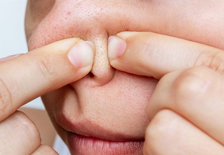 Việc thoa nhiều lớp sản phẩm nhất là có dầu lên mặt khi bạn là người da dầu có thể gây ra mụn đầu đen.