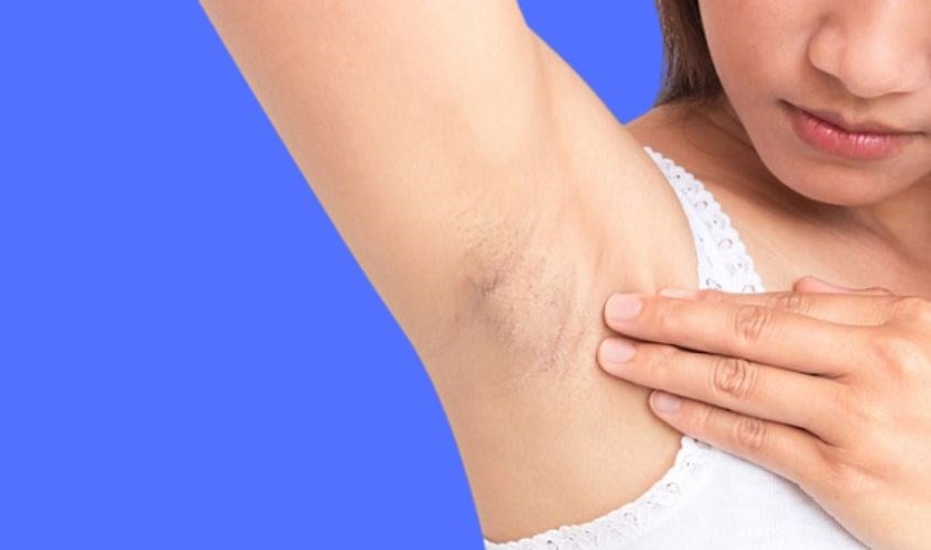 Dùng dao cạo có thể làm trầm trọng thêm vấn đề bằng cách gây kích ứng và khiến lông mọc ngược, góp phần làm xuất hiện vết thâm.
