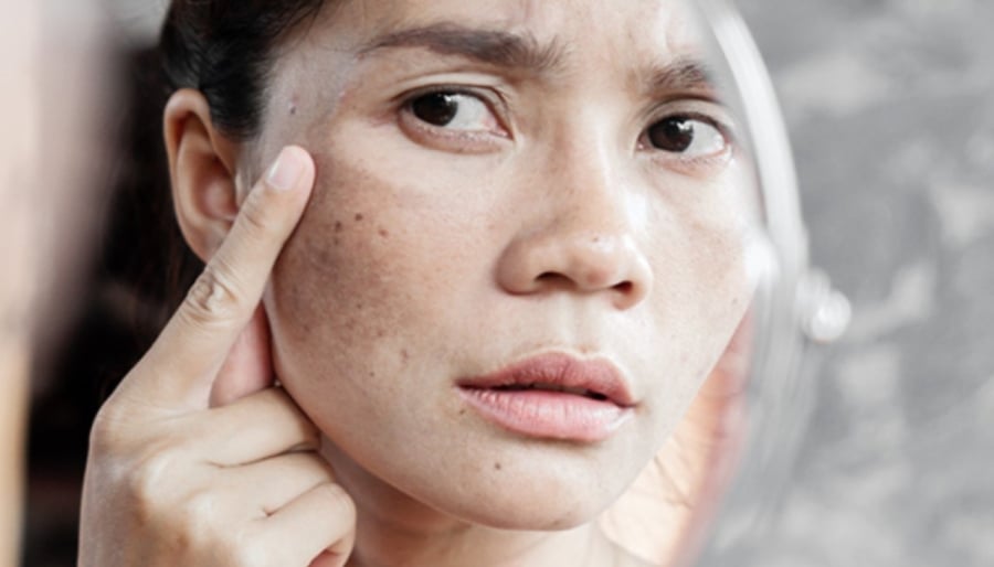 Tuổi già, việc xuất hiện các vết đồi mồi trên mặt là bình thường, nhưng không được quá nhiều. Nếu muốn bạn có thể loại bỏ và làm cho khuôn mặt trắng và sạch các vết đồi mồi nhanh chóng. (Ảnh minh họa)
