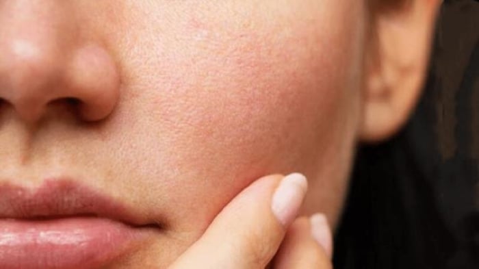 Làm da xuất hiện mẩn đỏ dễ khiến lớp bảo vệ da dễ bị tổn thương