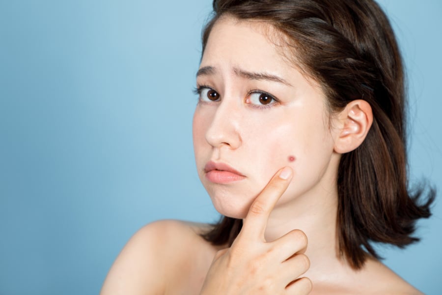 Thực phẩm nhiều dầu mỡ sẽ gây viêm và kích thích mụn trứng cá xuất hiện.