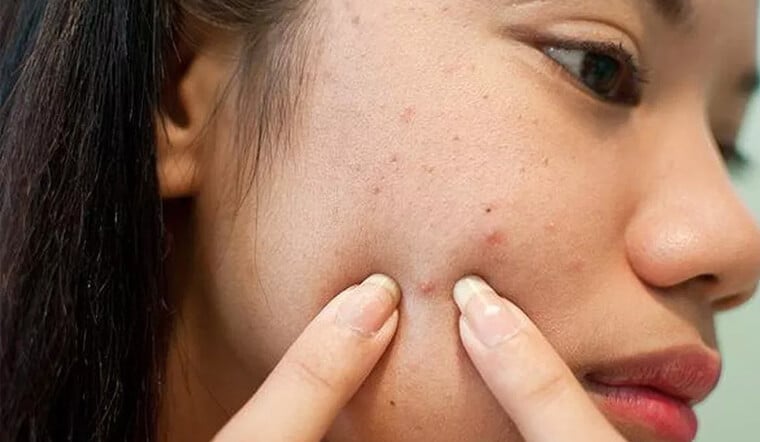 Bạn nên sử dụng các sản phẩm trị mụn chuyên dụng như kem hoặc mặt nạ.