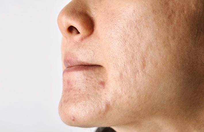 Sẹo rỗ tuy không gây ngứa, khó chịu nhưng làm mất thẩm mỹ, làn da kém mịn màng khiến chị em thiếu tự tin.