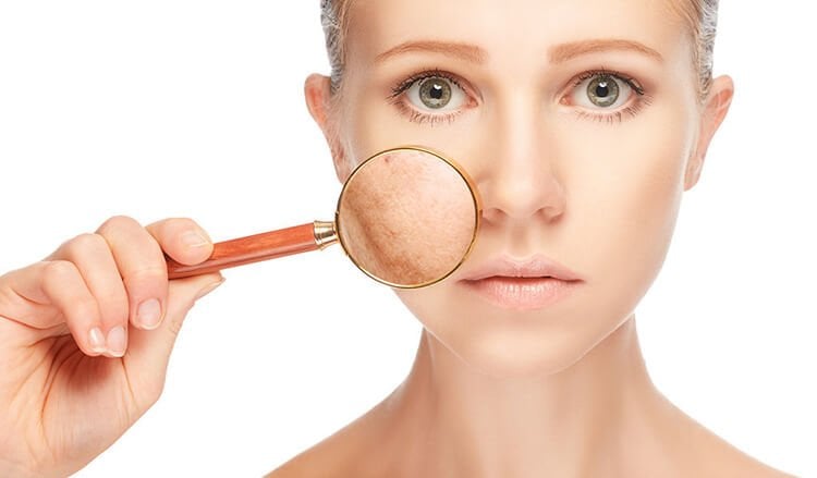 Việc thoa kem chống nắng SPF 30 trở lên vào mỗi sáng là cần thiết để ngăn ngừa sạm da.