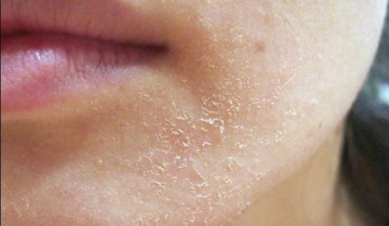 Thay đổi sang một loại thuốc có tác dụng tương tự theo hướng dẫn của bác sĩ có thể làm giảm tình trạng bong tróc da mặt.