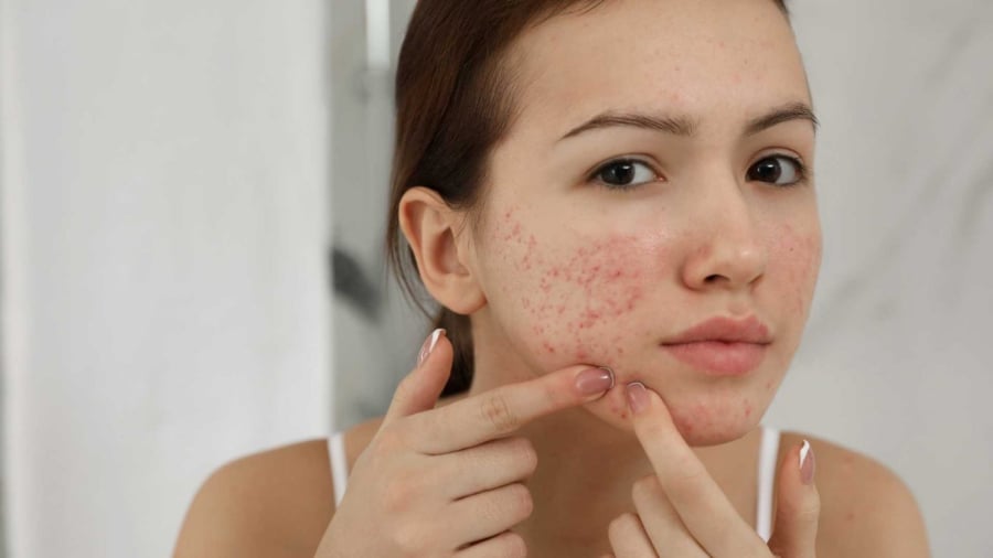Việc chạm vào vùng mụn thường xuyên có thể làm lây lan vi khuẩn từ móng tay, gây nhiễm trùng và viêm mạn tính.