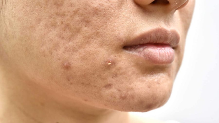 Sẹo mụn thường xuất hiện dưới dạng vết đỏ không đều, bề mặt da lồi lõm dó tổn thương lớp hạ bì.