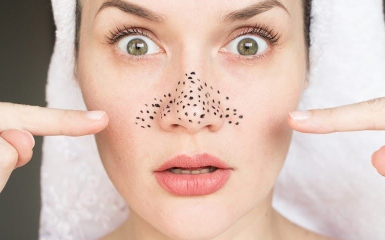 Một trong những nguyên nhân hàng đầu gây mụn đầu đen là thói quen sinh hoạt không khoa học.