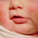 Cách phòng ngừa và chữa trị mọi vấn đề về da của trẻ sơ sinh