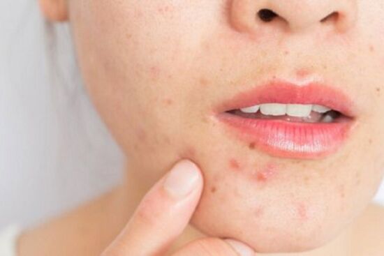 List những loại thực phẩm bạn nên và không nên ăn khi bị mụn để không để lại sẹo trên da