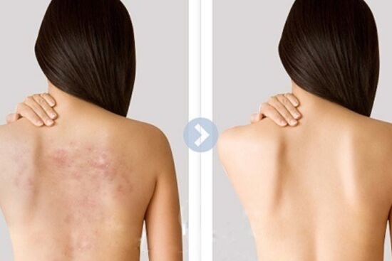 6 tips trị mụn ở lưng, tất cả chỉ đến từ những thói quen đơn giản thường ngày