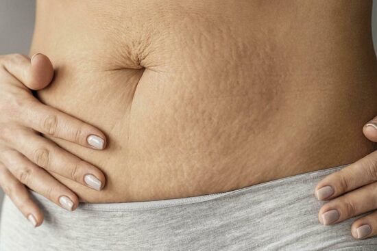 Rạn da khi mang thai – Cách phòng ngừa và điều trị