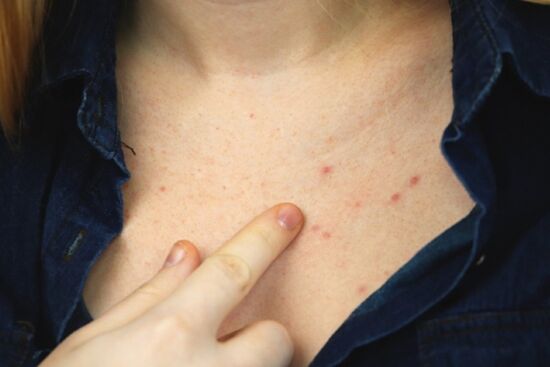 Mẹo đơn giản giúp giải quyết tình trạng nổi mụn ở ngực chị em nên biết