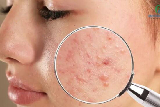 Sạch mụn chỉ trong 4 tuần nhờ áp dụng 5 thay đổi này