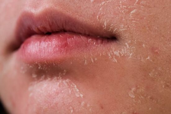 Ghim ngay những tips cơ bản chăm sóc da khô mùa đông, giảm khô nẻ và bong tróc vảy