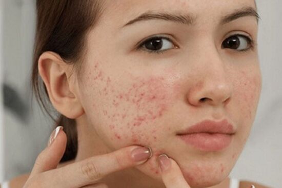 8 nguyên nhân gây mụn trứng cá