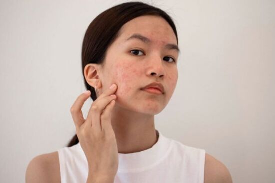 6 thủ phạm chính gây ra mụn khiến da mặt ngày càng xấu