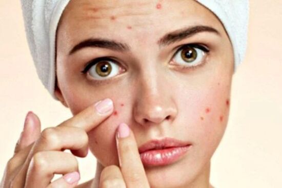 3 tác hại nghiêm trọng của thói quen nặn mụn