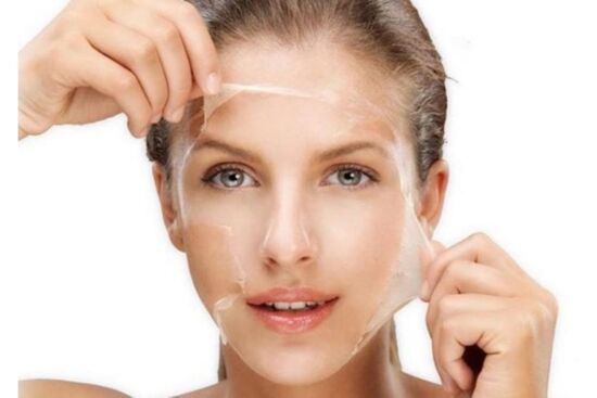 Trị nám bằng phương pháp lột da mặt có tốt không?
