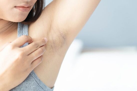 Mách nàng 10 cách để có vùng da nách trắng mịn, sạch vết thâm