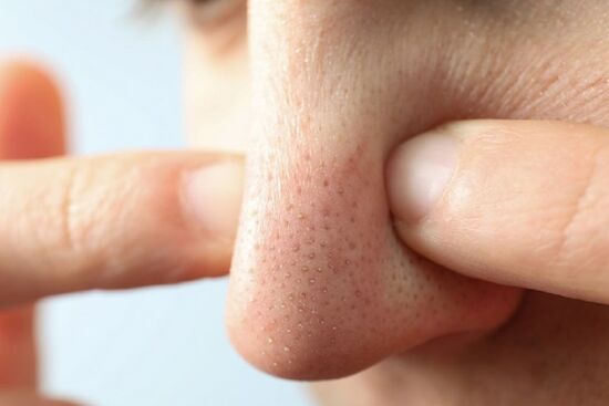 Tất tần tật những điều nên biết về mụn đầu đen