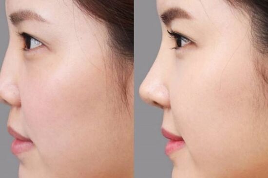 Nâng mũi có những loại nào? Các phương pháp nâng mũi phổ biến hiện nay