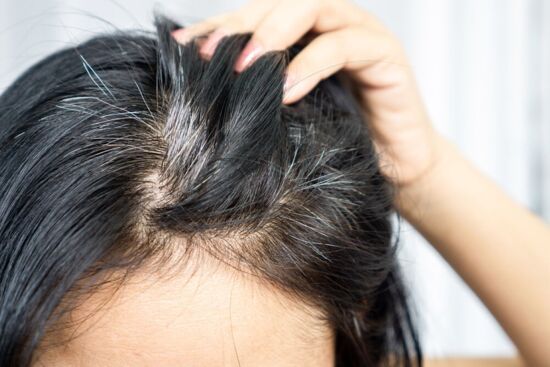 Tóc bạc sớm, không phải vì ‘xấu máu’ mà có thể do thiếu 5 chất dinh dưỡng này