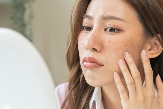 Nguyên nhân gây ra đốm đen, vết thâm và cách để giải quyết triệt để tình trạng này