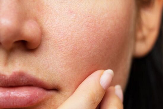 5 mẹo đơn giản giúp khắc phục tình trạng lỗ chân lông ngày càng to