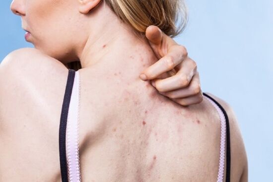 Mẹo giúp nàng xóa tan cơn "ác mộng" mụn lưng chi chít ngày hè
