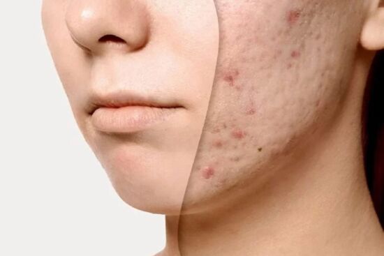 7 nguyên liệu trị dứt điểm làn da sần sùi, lỗ chân lông to