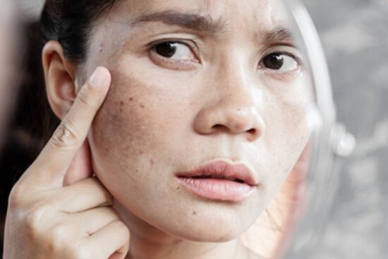 Mách bạn 6 chiêu làm mờ vết đồi mồi nhanh chóng
