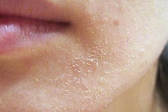 4 dấu hiệu cho thấy lan da của bạn đang trong tình trạng khẩn cấp, cần khắc phục ngay