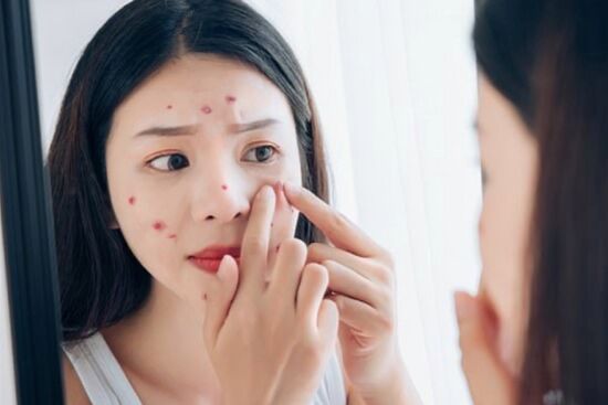 6 loại thực phẩm nên tránh xa nếu không muốn tình trạng mụn trứng cá trầm trọng hơn