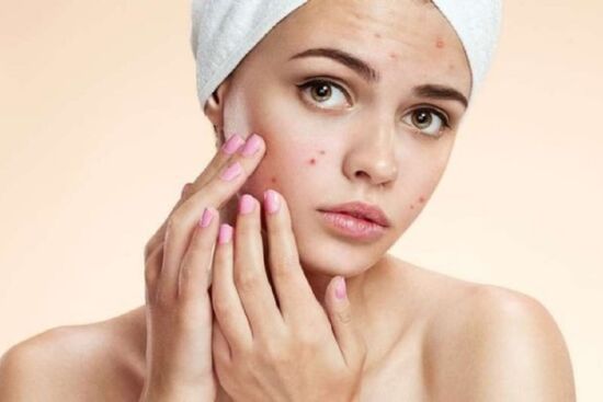 10 nguyên liệu thiên nhiên đánh bay mụn trứng cá, giảm vết thâm và sẹo hiệu quả