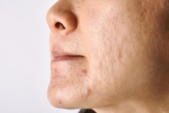 5 công thức xử lý sẹo rỗ tại nhà giúp là phẳng làn da nhanh chóng