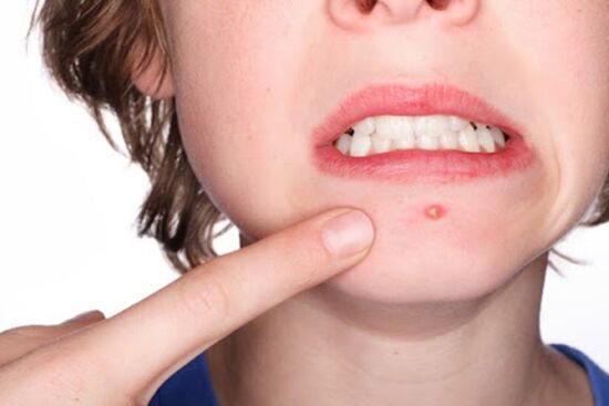 4 loại mụn không nên nặn vì dễ gây tổn thương da, nhiễm trùng và để lại sẹo