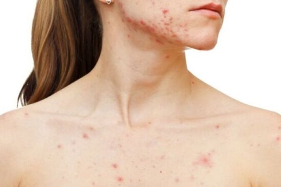 Nguyên nhân và loạt mẹo đơn giản giải quyết tình trạng mụn mọc ở cổ