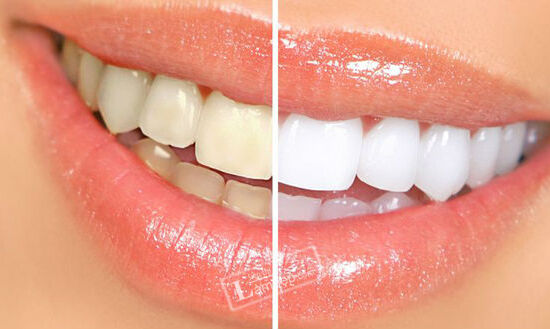 Cách làm trắng răng hiệu quả nhất tại nhà