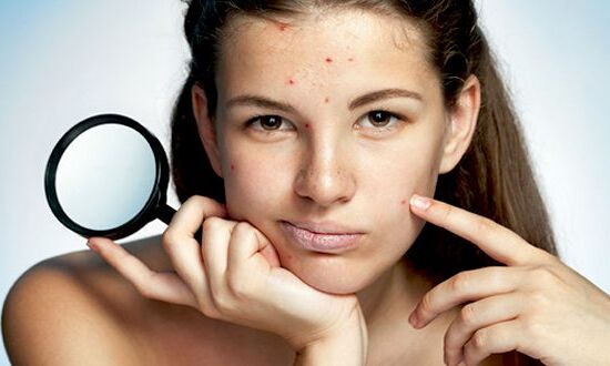 Mình đã tự chữa khỏi mụn như thế nào ?